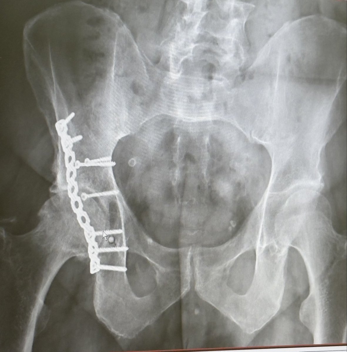 Humbled today. 
33 yr fracture has resurfaced itself w/intense pain. 
God reminded me today to drop that pride, it’s okay to ask for prayers. 
Not easy for a fireman. 
My total hip replacement will not be till Oct 2nd. 
The Good Shepherd still walks w/ me. 
Thank you family!🙏🏻❤️