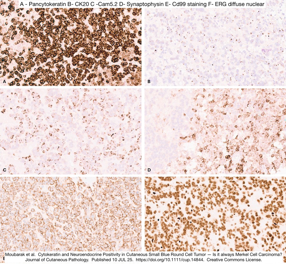 😮 Very interesting Skin Tumor

🧂 Looks like Merkel.  CK20 = perinuclear dot like.  Neuroendocrine markers +

🧬  BUT CD99 diffusely membraneous and EWSR1-ERG fusion t(21;22) ---&gt; (Primary) Cutaneous Ewing's! 

Open Access Article (Moubarak et al) ⬇️ 
doi.org/10.1111/cup.14…