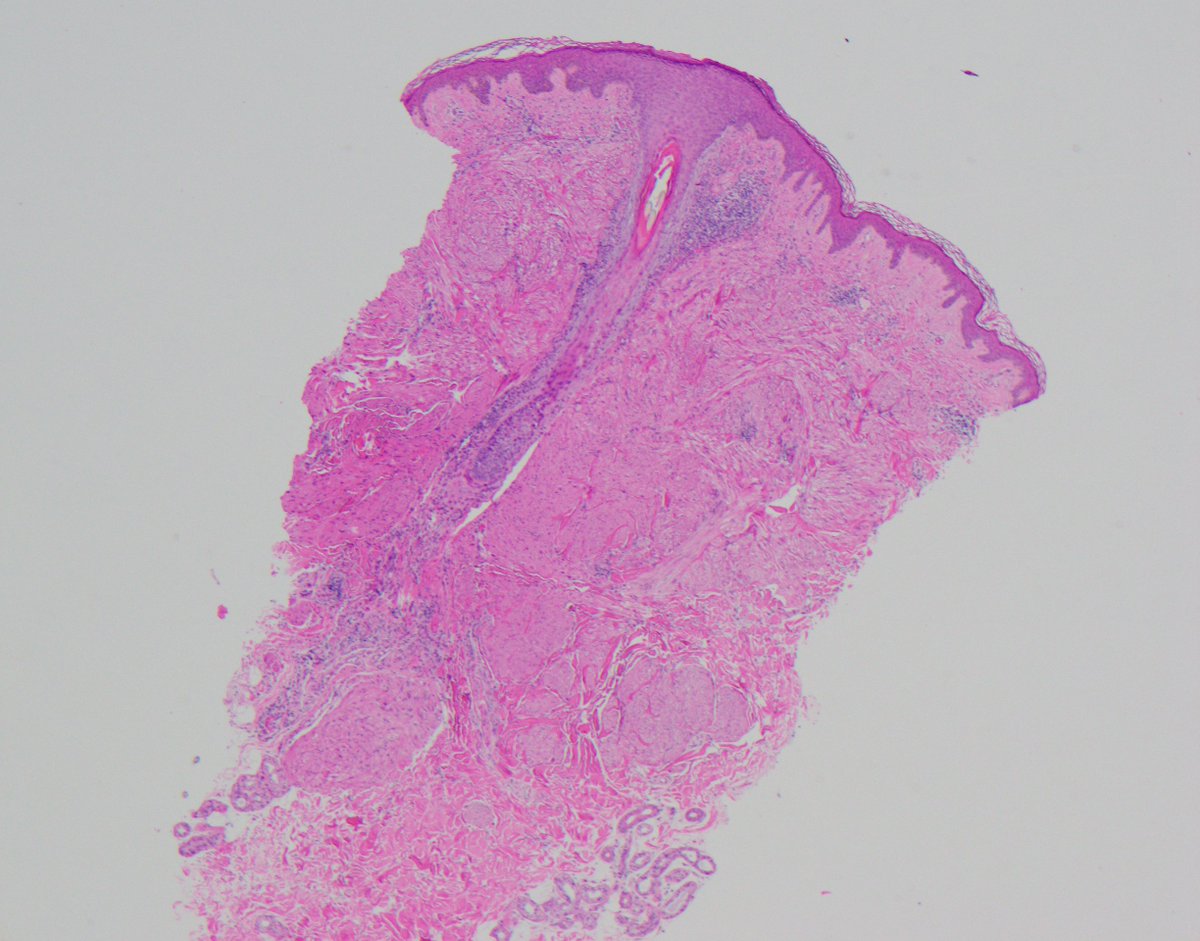 CaDxPath's tweet image. Skin lesion 40 year old male.

Who else always undertakes fumarate hydratase IHC and 2SC IHC in cutaneous leiomyomas. We always do.

Practice hint, immunohistochemistry for FH can be difficult to interpret in cutaneous leiomyomas. This is because they are always associated with…