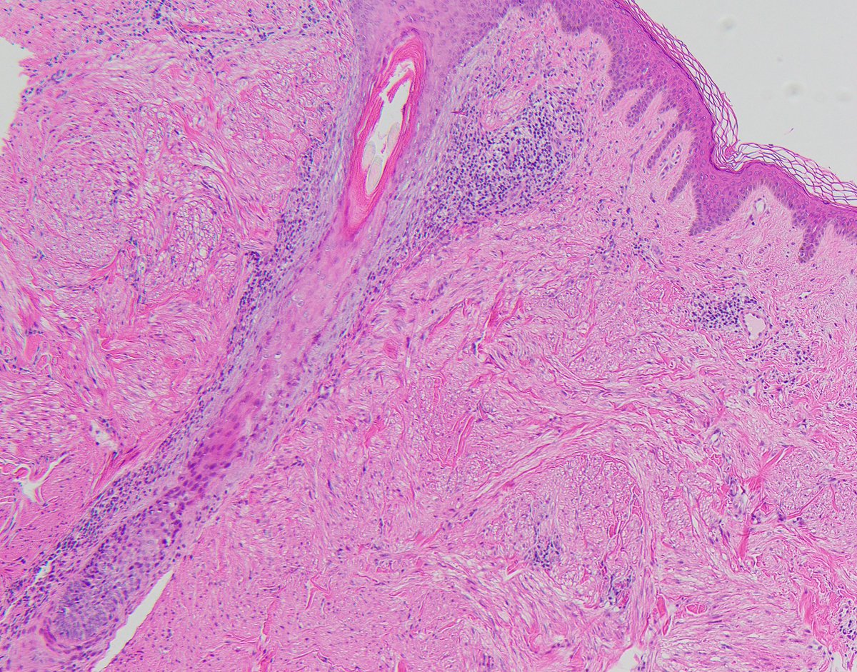 CaDxPath's tweet image. Skin lesion 40 year old male.

Who else always undertakes fumarate hydratase IHC and 2SC IHC in cutaneous leiomyomas. We always do.

Practice hint, immunohistochemistry for FH can be difficult to interpret in cutaneous leiomyomas. This is because they are always associated with…