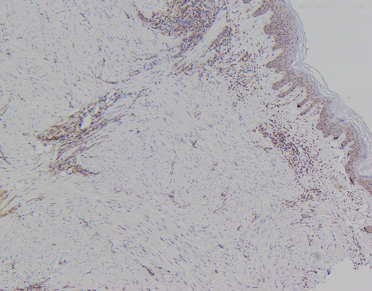 CaDxPath's tweet image. Skin lesion 40 year old male.

Who else always undertakes fumarate hydratase IHC and 2SC IHC in cutaneous leiomyomas. We always do.

Practice hint, immunohistochemistry for FH can be difficult to interpret in cutaneous leiomyomas. This is because they are always associated with…