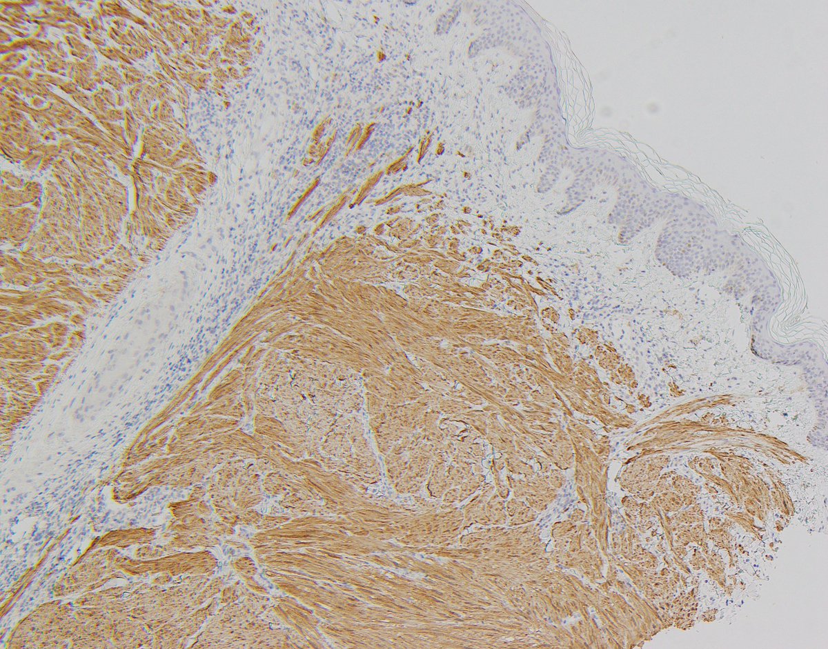 CaDxPath's tweet image. Skin lesion 40 year old male.

Who else always undertakes fumarate hydratase IHC and 2SC IHC in cutaneous leiomyomas. We always do.

Practice hint, immunohistochemistry for FH can be difficult to interpret in cutaneous leiomyomas. This is because they are always associated with…