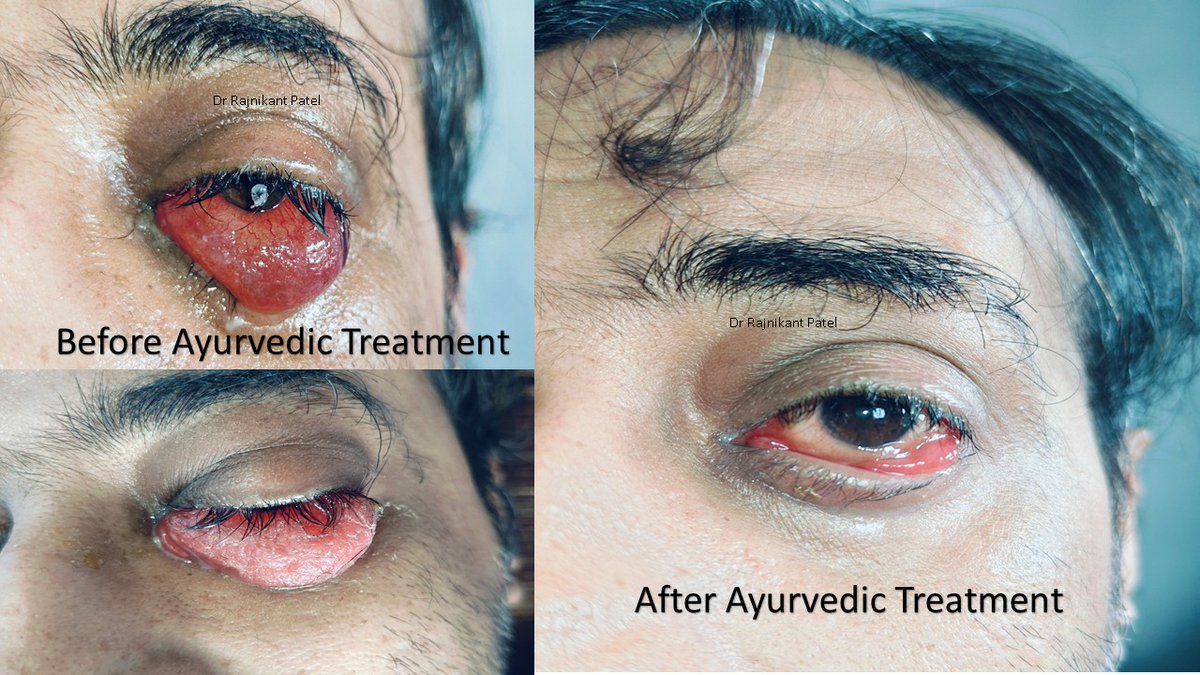 🌿 To All Who Doubt Ayurveda—Just Look At This! 🌿

Here’s living proof that Ayurveda is NOT just theory—it's REAL medicine.

This patient was diagnosed with rhino-orbital mucormycosis—a condition where many believe the only option is to remove the eye.
But look at the