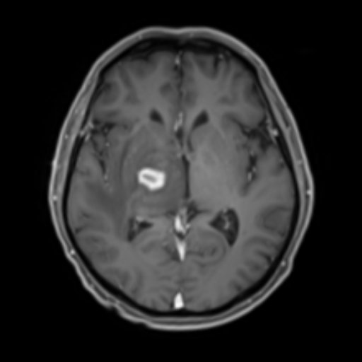 Doctors_GUILD's tweet photo. HIV patient with multiple ring-enhancing brain lesions

A) Cryptococcosis
B) PML
C) Toxoplasmosis 
D) TB meningitis https://t.co/DZlzytnk5I