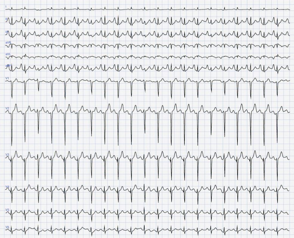 Pedram (@ecgloverr) on Twitter photo 72 y/o smoker man with palpitations
Digitalized by <a href="/PMcardioApp/">PMcardio—AI that reads ECGs</a>
#ecg #ekg #cardiology #CardioEd #CardioTwitter #MedTwitter #foamed #cardiologist 72 y/o smoker man with palpitations
Digitalized by <a href="/PMcardioApp/">PMcardio—AI that reads ECGs</a>
#ecg #ekg #cardiology #CardioEd #CardioTwitter #MedTwitter #foamed #cardiologist