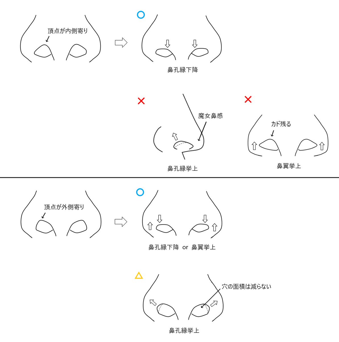 dr_sakano's tweet photo. 鼻の穴の三角形。
頂点の位置により術式が異なります。
実際には軟骨の柔軟性なども影響しますがざっくりと。
鼻孔縁下降・鼻翼挙上は面積が減りますが、鼻孔縁挙上はカドをなだらかにするので面積は減りません（やや増えることも）
また内側寄りの鼻孔縁挙上は切り上げが増え魔女鼻になり易いです https://t.co/jqwmbZHtVP