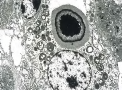 Pascual Meseguer (@histopatolomon) on Twitter photo <a href="/yro854/">Yale Rosen</a> Ultrastructure with a large round laminated mineralized cytoplasmic body #malakoplakia
From Bladder pathology, L. Cheng ISBN 978-0-470-57108-8 <a href="/yro854/">Yale Rosen</a> Ultrastructure with a large round laminated mineralized cytoplasmic body #malakoplakia
From Bladder pathology, L. Cheng ISBN 978-0-470-57108-8