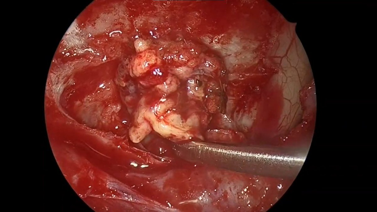 TheJNS's tweet image. #OperativeVideo Endoscopic transorbital approach for repair of spontaneous CSF leak and frontal sinus encephalocele
thejns.org/video/view/jou…