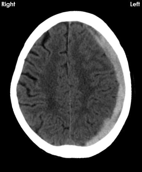 CT BRAIN 11: What does this CT brain show? What are the risk factors for this abnormality? Answer buff.ly/3WlPR3T