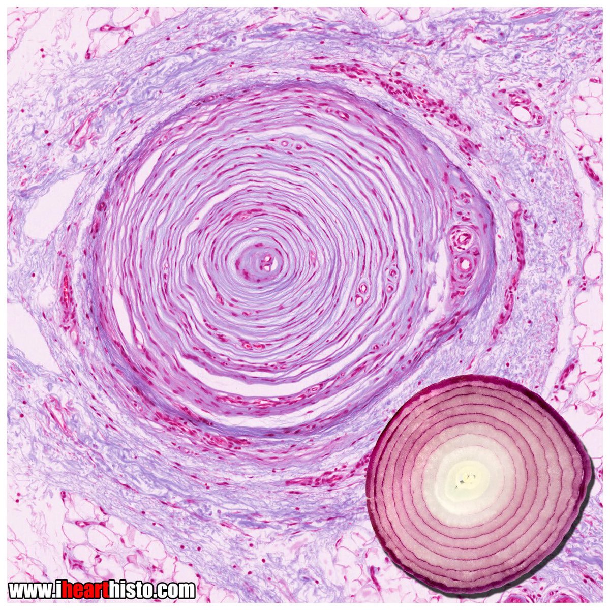 Which conditions in medicine are associated with onion skin changes?