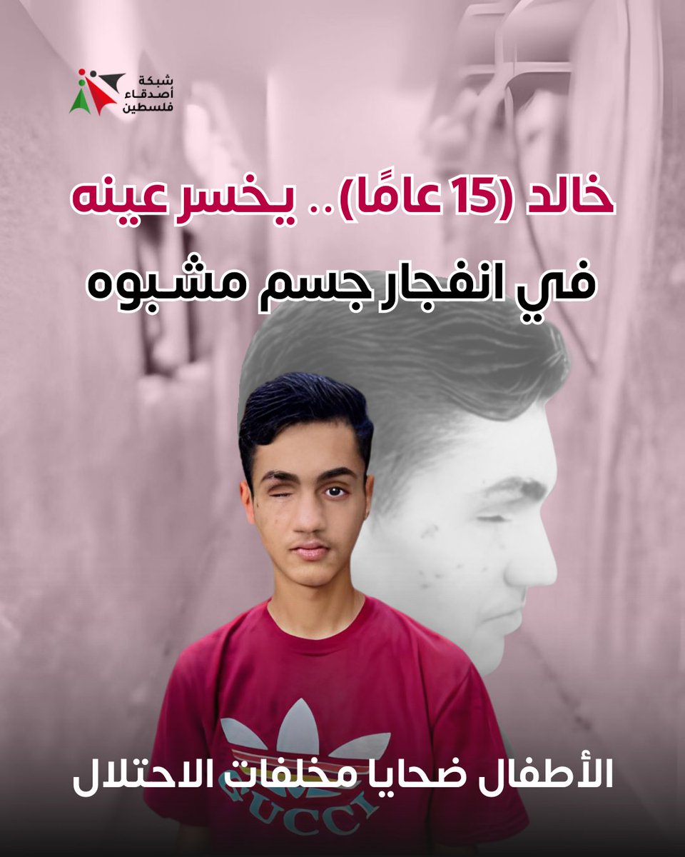 خالد حلاوة، طفل في الخامسة عشرة، فقد عينه اليمنى بسبب جسم متفجر تركه الاحتلال الإسرائيلي خلّفه بعد انسحابه من خانيونس. منذ ذلك اليوم يعيش خالد صدمة نفسية عميقة بسبب التشوه.  خالد يحتاج إلى السفر لزراعة عين وتلقي علاج نفسي وجسدي عاجل..ولكنه حبيس الحصار كباقي أطفال #غزة المصابين‼️