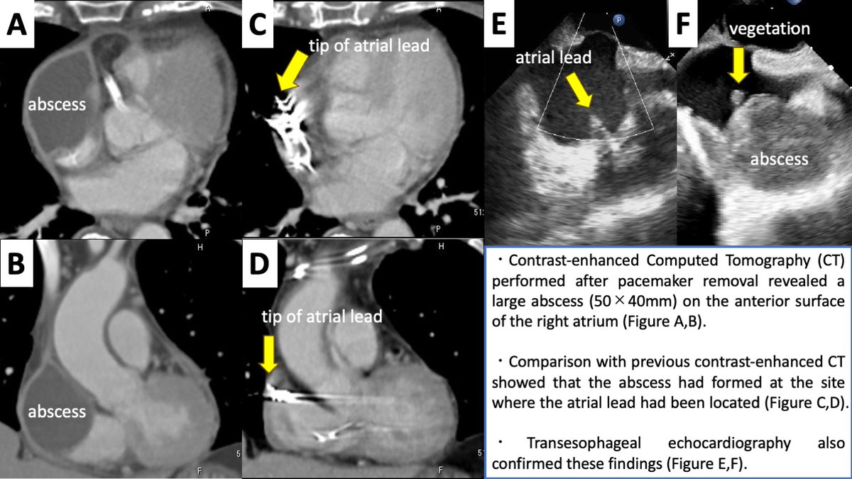 A 74-year-old woman developed bacteremia and pericarditis after DDD pacemaker insertion. Despite treatment, an abscess formed on the right atrium, indicating infection spread from the atrial lead tip.
By Hiroki Yokomori
doi.org/10.1253/circre…
#circ_rep #CardioX