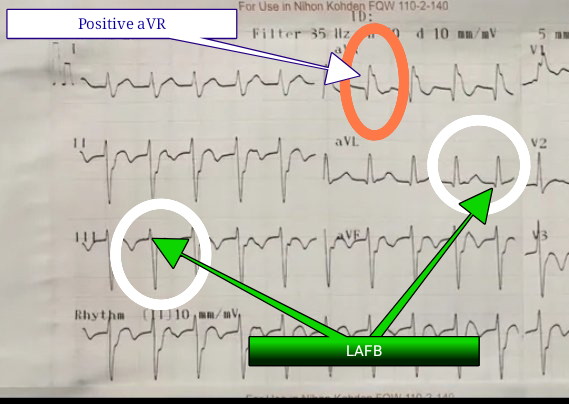 #ecg shows WCT with HR ~135bpm;

It has (+) VT signs:
1. Atypical RBBB with tall left rabbit ear
2. Positive aVR
3. r/S &lt; 1 in V6 with LAD.
4. AV dissociation

Fulfill 4/4 criteria for Fascicular VT
1. Atypical RBBB 
2. QRS &lt;140msec
3. r/S&lt;1 in V6
4. (+)aVR