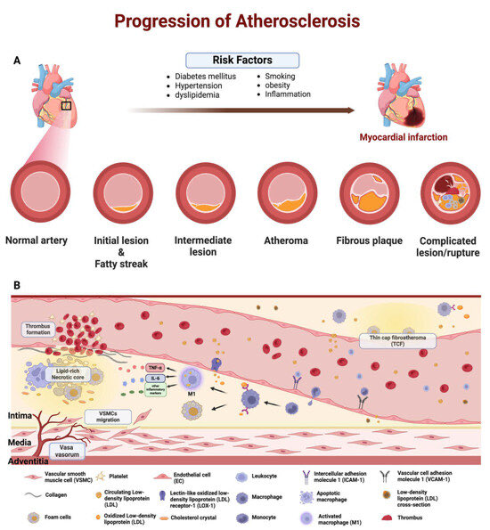 #VICTORIONplaque follow up is ending. Glad to have been one among the Coinvestigators and thanks to Novartis which wlll to randomized individuals to keep the treatment whereas is not yet on the market ☀️