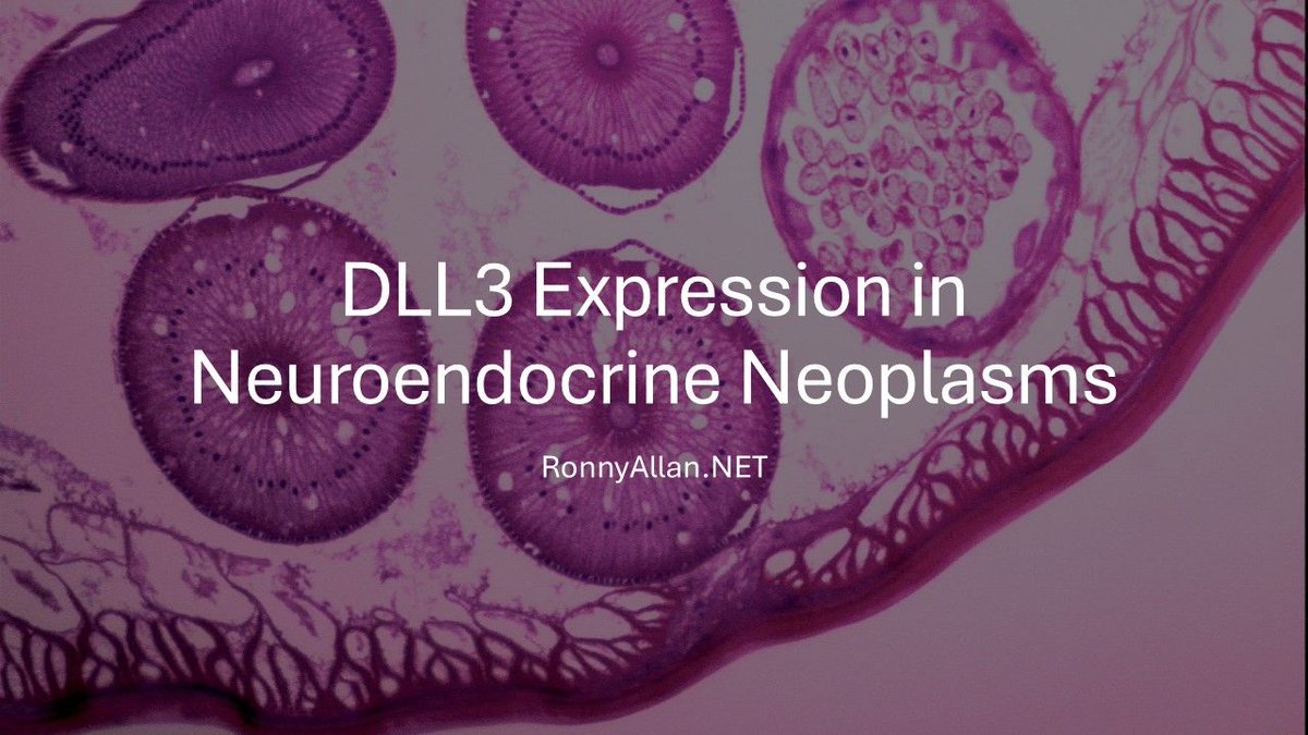 DLL3 Expression in Neuroendocrine Neoplasms – an overview buff.ly/vpNksUW