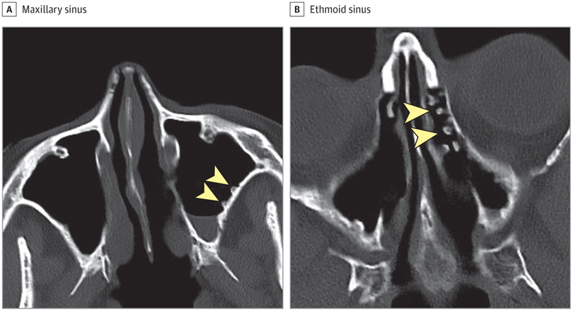 JAMAOto's tweet image. A 64-year-old woman was referred for continued management of long-standing chronic rhinosinusitis without nasal polyps.
What is your diagnosis? ja.ma/44s3z9Q