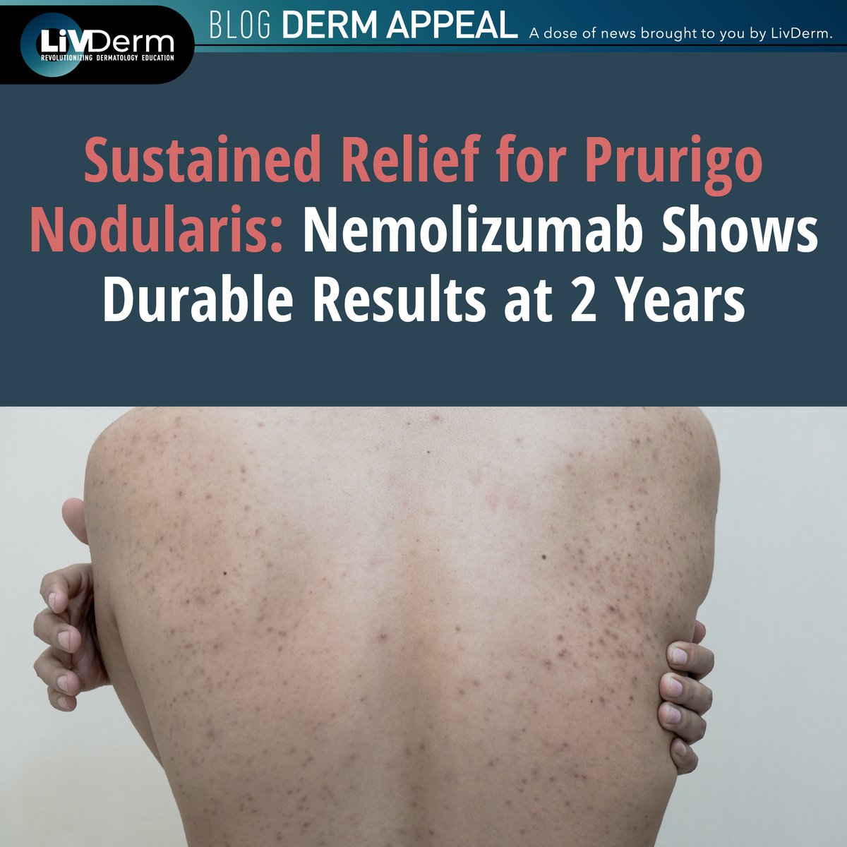 💡 New research shows nemolizumab continues to deliver sustained relief for prurigo nodularis (PN) patients even after two years of treatment.

Read more about this therapeutic option that's changing the PN treatment landscape 👉 go.livderm.org/3TsLRfY

#PrurigoNodularis
