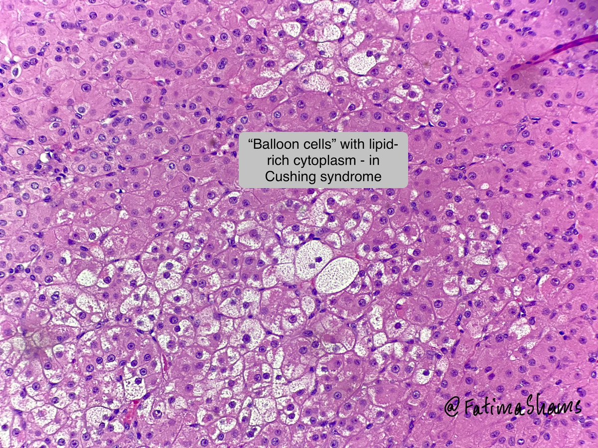 📣 Adrenal Adenoma – Cushing Syndrome (Pediatric Case)

👉 🧒🏼 12-year-old male with classic Cushingoid features.

📌 Gross features:
•Well-circumscribed, solitary adrenal mass
•Yellow to golden-brown cut surface
•Sharp demarcation from normal adrenal cortex

📌 Microscopy: