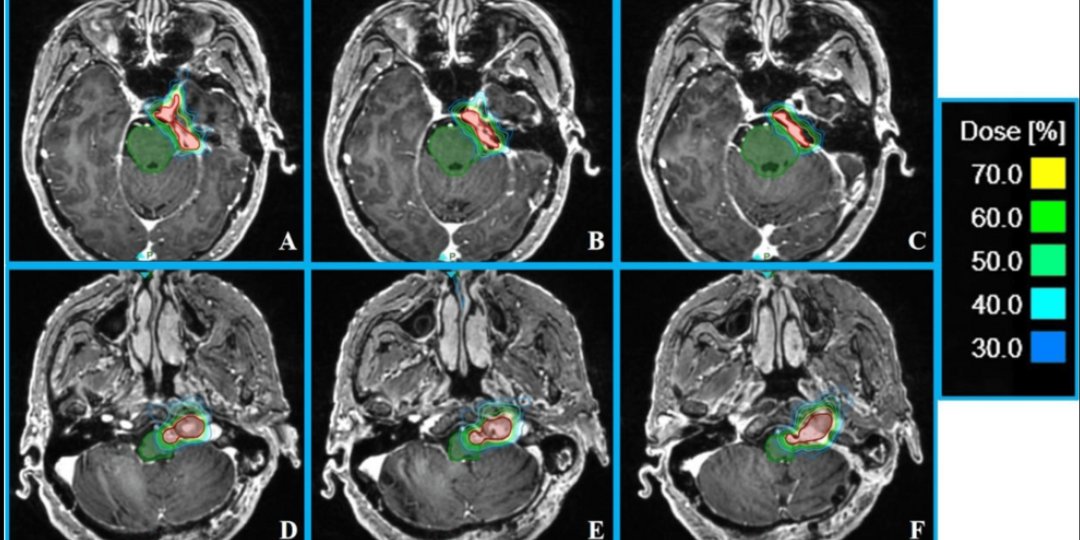 Two meningioma cases treated with ZAP-X radiosurgery showed no deficits or major side effects over 4 years highlighting its promise as a safe, precise, non-invasive brain tumor therapy.

Read more: hubs.la/Q03wCx3K0

#Cureus #ZAPX #Neurosurgery #BrainTumor #Oncology