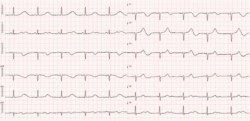 smithECGBlog's tweet image. Why did it take 70 years for this to cause trouble? And what are the markers of risk in this ECG?
drsmithsecgblog.com/why-did-it-tak…
@MagnusNossen