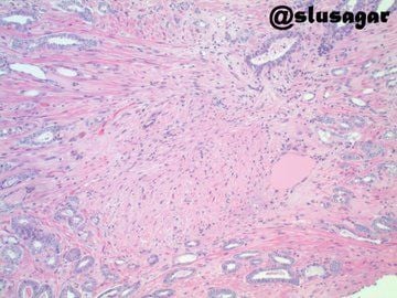 in #breastpath excisional specimen, though we frequently 👀🔬biopsy site changes, still important to document in path report.

oddly enough, uncommon to 👀🔬biopsy site changes in #GUpath prostatectomies (see pics).  unclear how important to document this infrequent finding