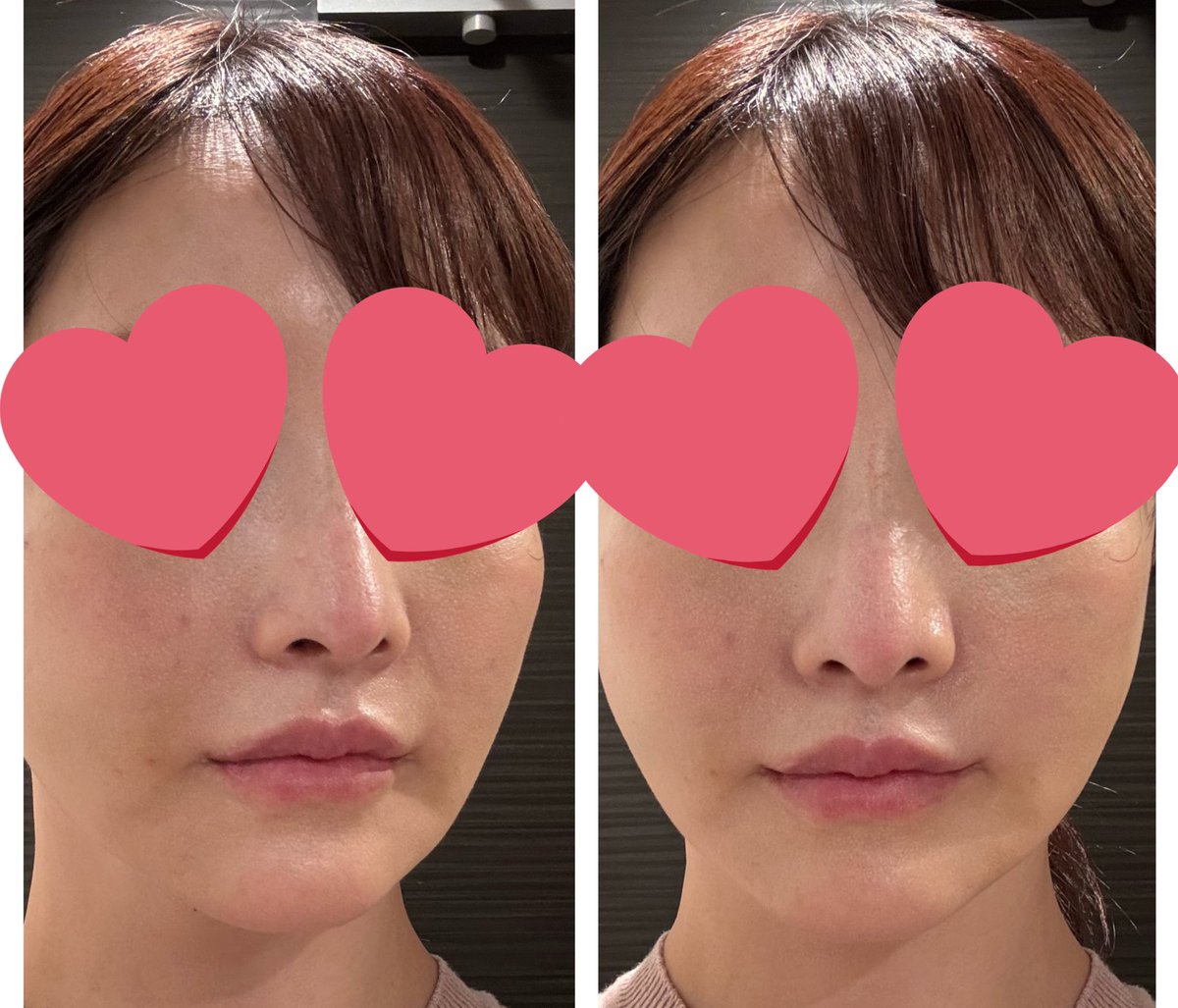 ほうれい線にジュブゼン良かったので、完全自腹だけど進んで長文レポ😊💓
クリニック🏥ジェニー美容クリニック
ほうれい線パッケージ99万w（約10万）
ほうれい線にジュブゼン＋糸を入れるのでかなりお得🉐