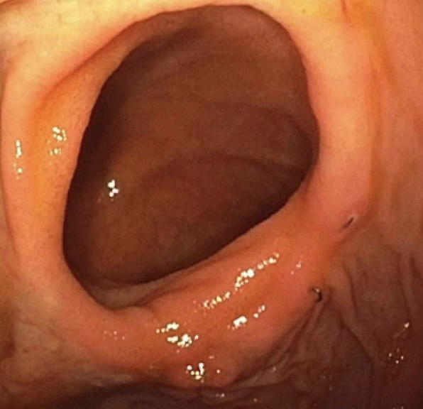 #IBD S/P Surgery, stricture, hospitalization, one session of endoscopic stricturotomy, picture 2, one one-year follow-up with wide open anastomosis.
#endoscopy #GITwitter #Crohnsdisease