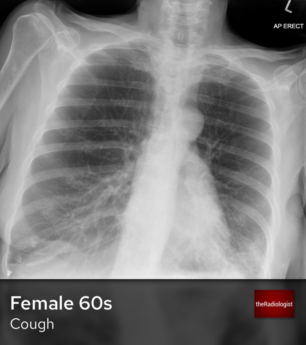 radiologistpage's tweet image. A female in her 60s presents with a cough on a few month history of weight loss. What does the Chest X-Ray show?