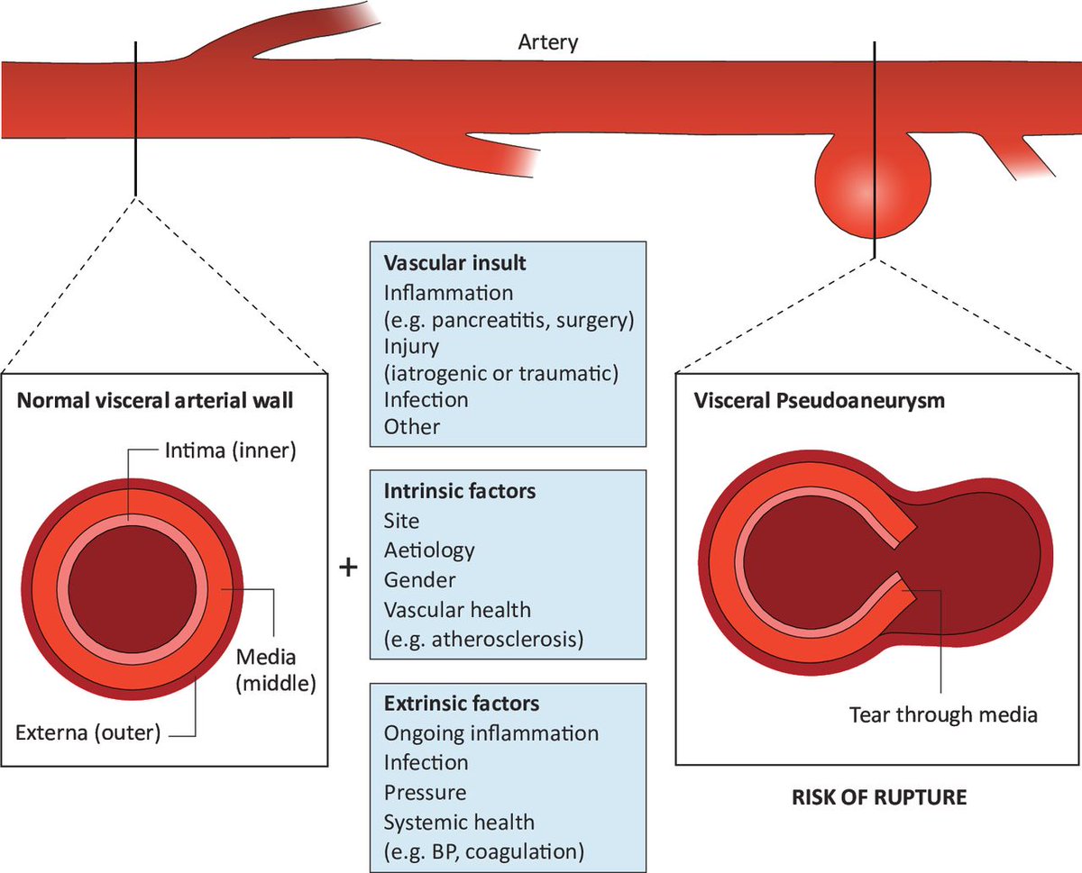 🔁 Revisiting a hidden gem from our recent releases

Visceral artery pseudoaneurysms 🩸
Uncommon, often missed — but can be catastrophic.

🧠 Spot it radiologically
💥 Treat fast
👥 MDT essential

Brilliant review by <a href="/Sam_Pannick/">Sam Pannick</a> and team — a must-read for anyone dealing with GI