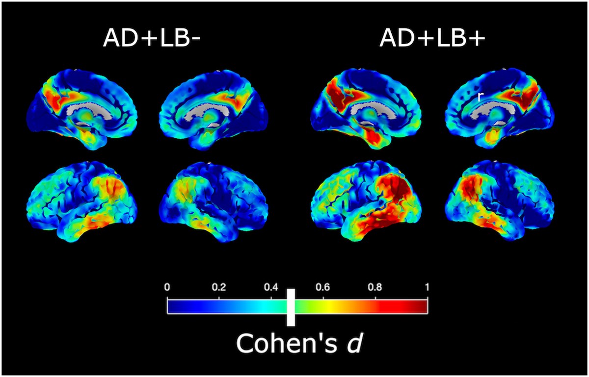 Brain1878's tweet image. Silva-Rodríguez et al. show that patients with AD with Lewy body (LB) pathology experience faster cognitive decline and more severe hypometabolism than pts without this pathology. However, LB pathology is not associated with atypical phenotypic features. tinyurl.com/mw3ap5p2