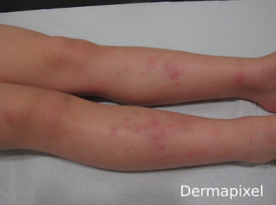 SCPed's tweet photo. 🧐"Una niña con bultos en las piernas". Cas dermatologia pediàtrica al blog #Dermapixel de @rosataberner https://t.co/u2rNeSIc4G https://t.co/oezXiDuSlK