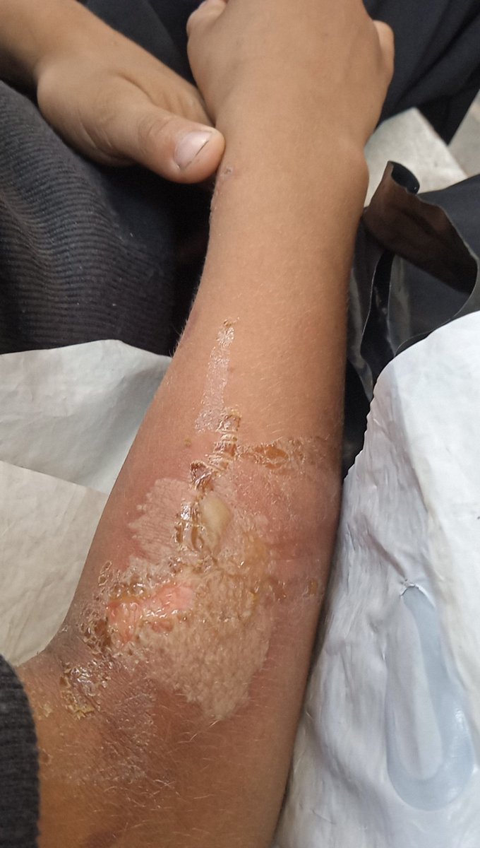 AsmBdwn37631's tweet image. My little son was injured today by nearby shelling. Donate and share
#VerifiedByRadioWatermelon