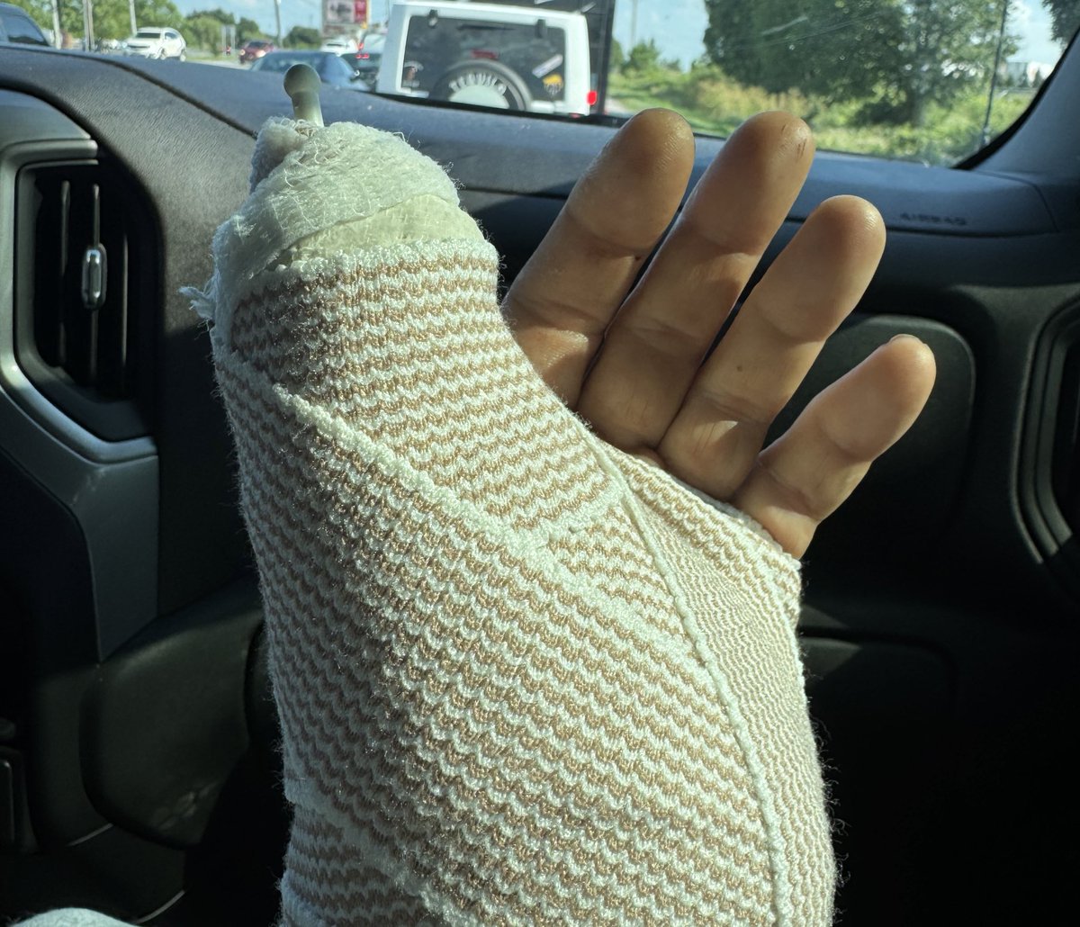 RepThomasMassie's tweet image. They can shove a metal pin up my thumb and I still won’t vote for it!
What really happened: A drunkard hit my cattle fence this week, and in my rush to repair it before it got dark, I shattered the bone in my thumb using a fence post driver. Exposed compound fracture… Ouch!!