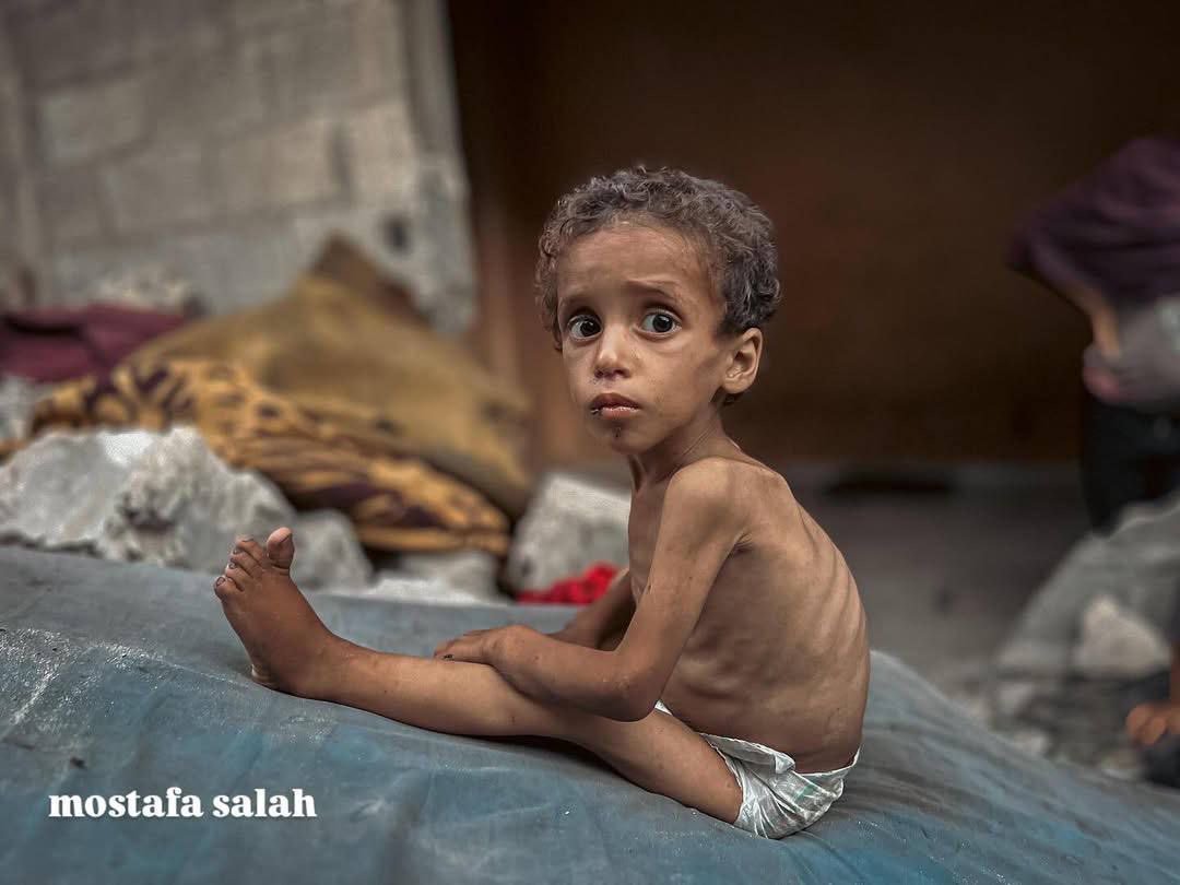 Yazan Mahmoud Atiya Abu Foul est un enfant parmi plus de 66 000 à Gaza souffrant de malnutrition aiguë. Son corps s’affaiblit chaque jour, privé de soins, de nourriture et d’abri, alors que le blocus prolongé continue d’étouffer toute aide humanitaire.

📆 Données : juillet 2025