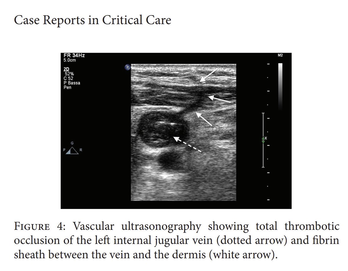 this is interesting

possible air entry even many hours after CVC removal

pubmed.ncbi.nlm.nih.gov/24829822/

At vascular ultrasonography a tract between the vein and dermis was responsible for air embolism, which was still visible more than 24 hours after air occlusive dressing placement