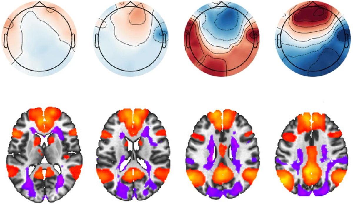 Brain1878's tweet image. Kazazian et al. review the use of neuroimaging in disorders of consciousness, detailing key methods (fMRI, EEG, PET) and imaging paradigms that can be used to improve diagnosis and prognosis. tinyurl.com/bddyanm4