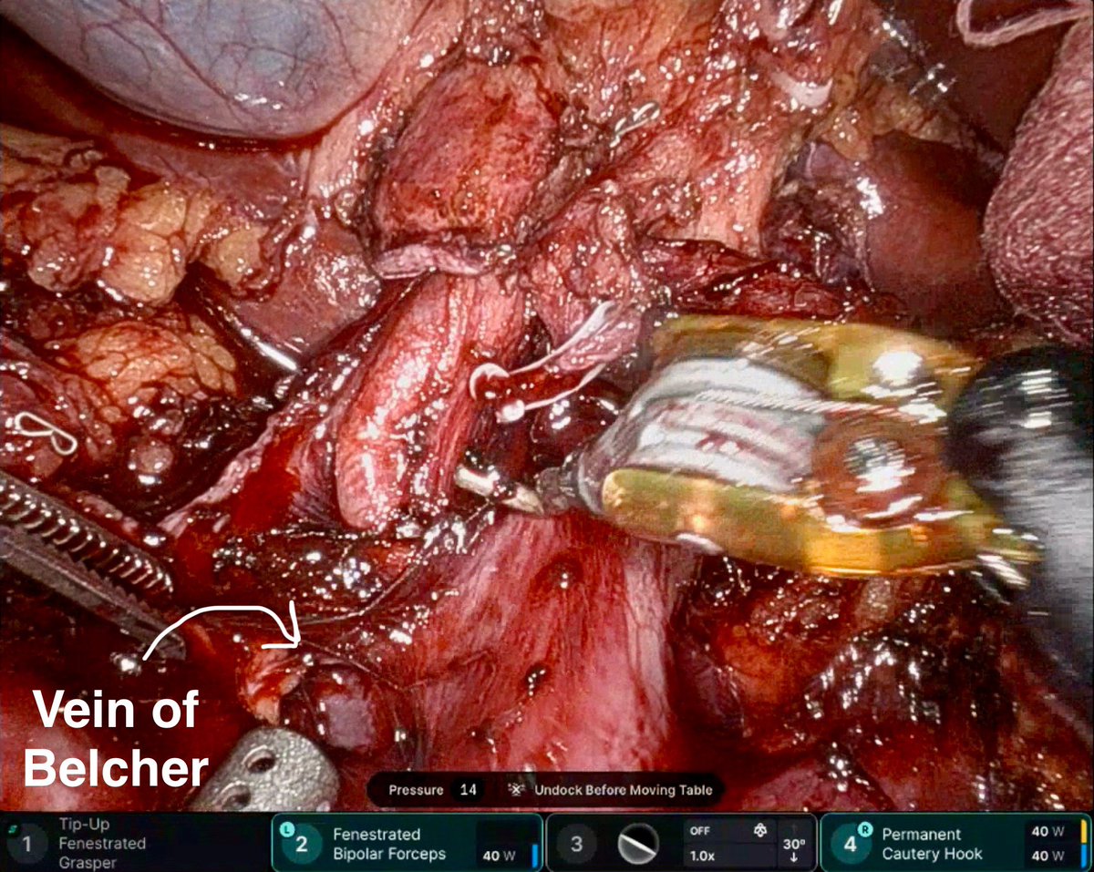 Agreed w ⬆️ visualization but its strength can also be a pitfall. 10x mag=you’re closer than you would be open, so beware of thermal injury➡️PSA.

Recently had a case of rRHA, nLHA, and aLHA! But the rRHA/rCHA is also an important landmark: Vein of Belcher is always just below.