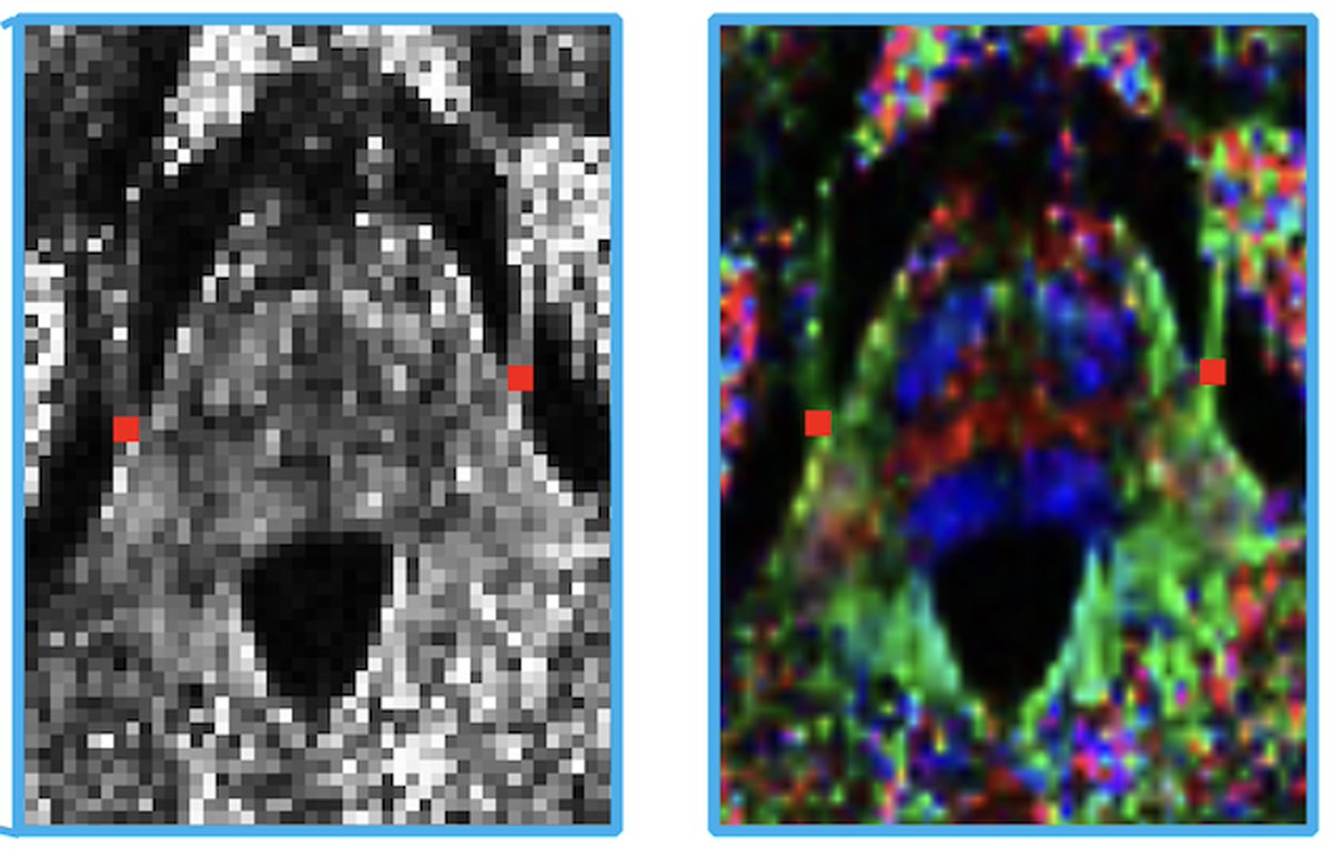 Brain1878's tweet image. Using multimodal imaging, Tohyama et al. show that individuals with migraine have white matter damage in the trigeminal nerve, which is associated with neuroinflammation and with reduced communication with a key trigeminal sensory nucleus in the brainstem. tinyurl.com/3ue76n8e