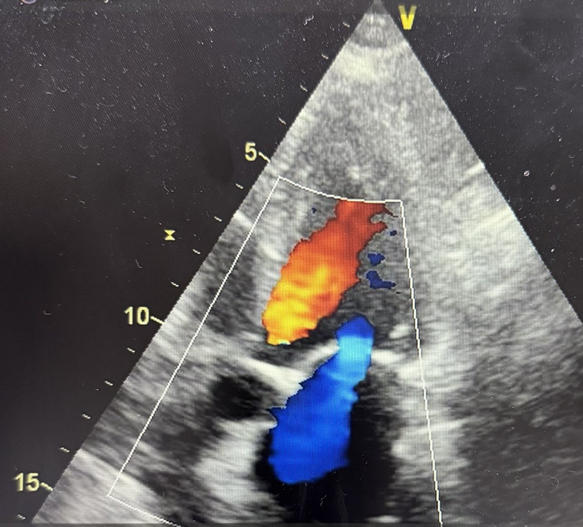 Echo quiz for residents and fellows. What are the jets ?