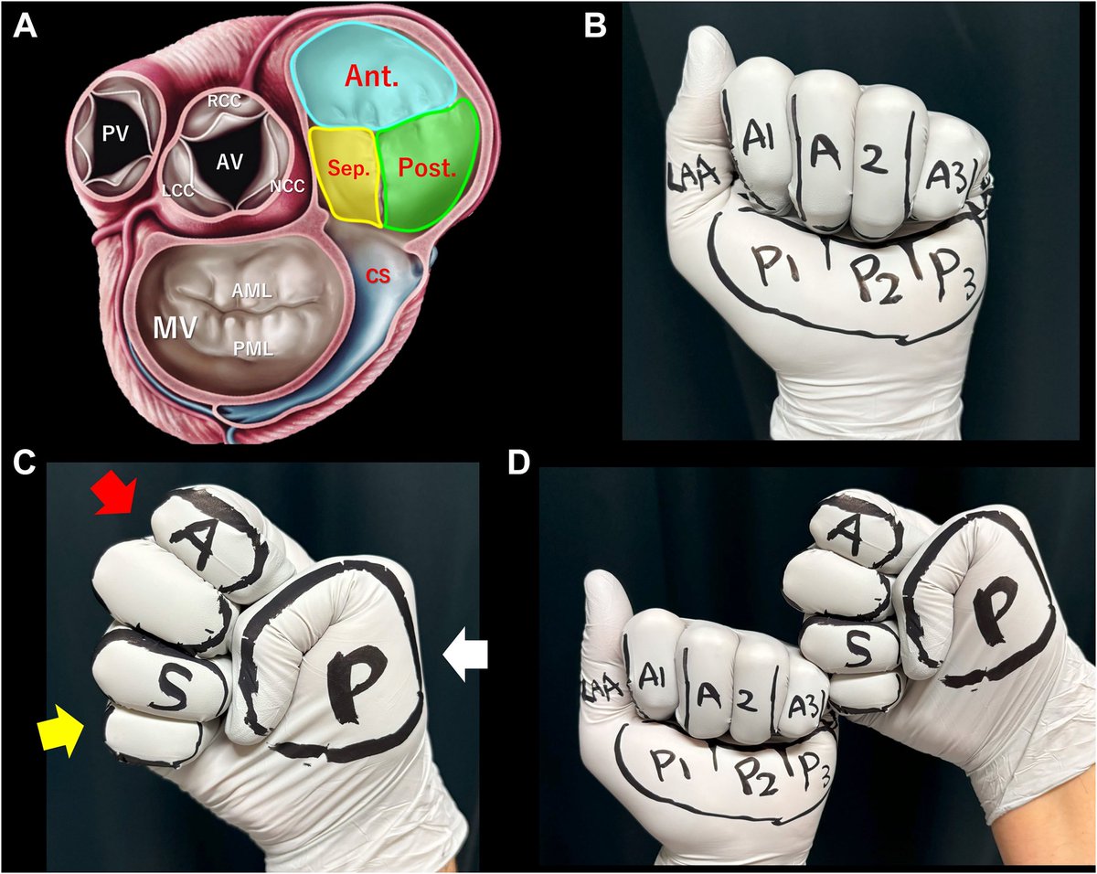 Interesting 🧐 
Hand Model to Determine the Anatomy and Spatial Relationships of Tricuspid Valve Leaflets.
#POCUS #echofirst #FOAMed #FOAMcc 
🔗 sciencedirect.com/science/articl…
