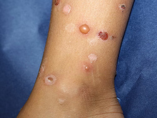 A 10-year-old boy presented  for evaluation of “itchy bumps” on the arms and legs over several months. The exam shows erythematous papules and vesicles on the upper and lower extremities, along with scattered crusted lesions and hypopigmented ring lesions  medscape.com/viewarticle/10…