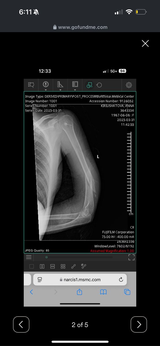 exceptionalgem's tweet photo. Dear friends of X, I have a close friend who was denied surgery due to her immigration/insurance status to fix her broken arm. She is now fundraising for her surgery to save use of her arm, please any share/repost/donation means the world!!! 

https://t.co/iDthNAC3Pg https://t.co/k4zFL4kzRS