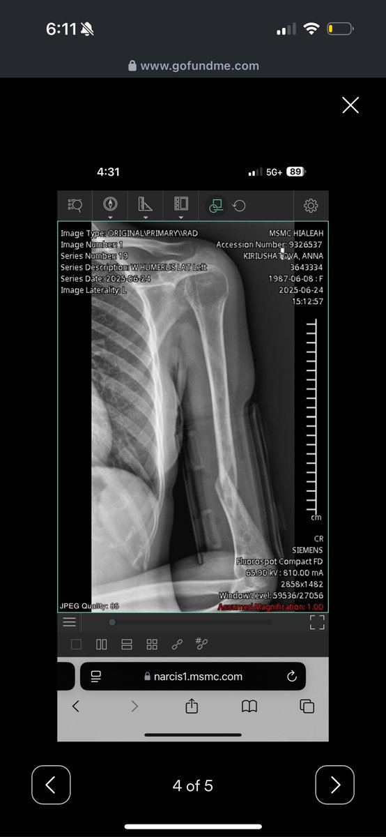 exceptionalgem's tweet photo. Dear friends of X, I have a close friend who was denied surgery due to her immigration/insurance status to fix her broken arm. She is now fundraising for her surgery to save use of her arm, please any share/repost/donation means the world!!! 

https://t.co/iDthNAC3Pg https://t.co/k4zFL4kzRS