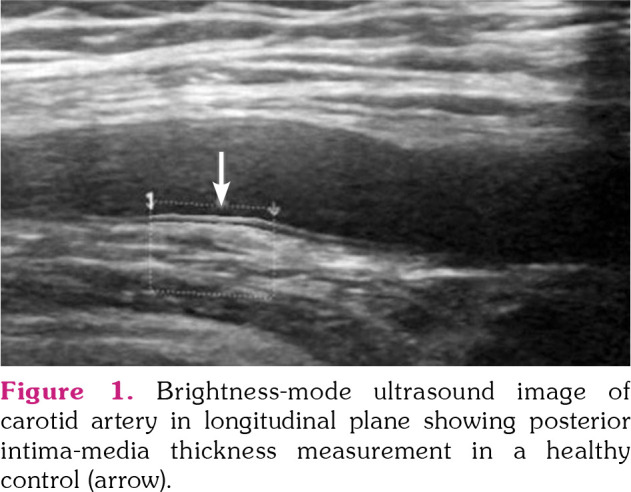 Ultrasonographic measurement of the vascular wall thickness and  intima-media thickness in patients with Behçet’s disease with symptoms  or signs of vascular involvement: A cross-sectional study
pmc.ncbi.nlm.nih.gov/articles/PMC84…