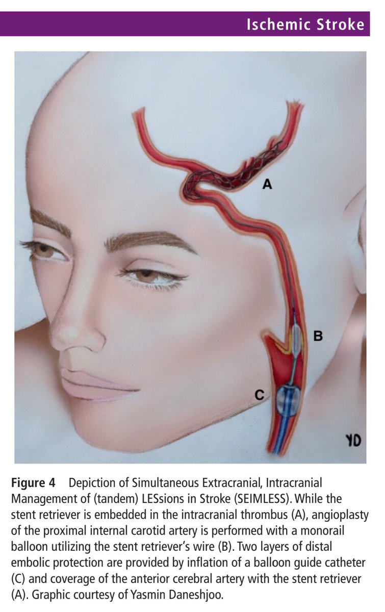 NeuroIRdoc's tweet photo. Had a tandem occlusion today and I blanked out on the stent retriever step. Sharing my mentor @oozaidat famous paper here on the SEIMLESS technique for all of us to recall and reference

https://t.co/hEr9SJOVpx https://t.co/neha59jpii
