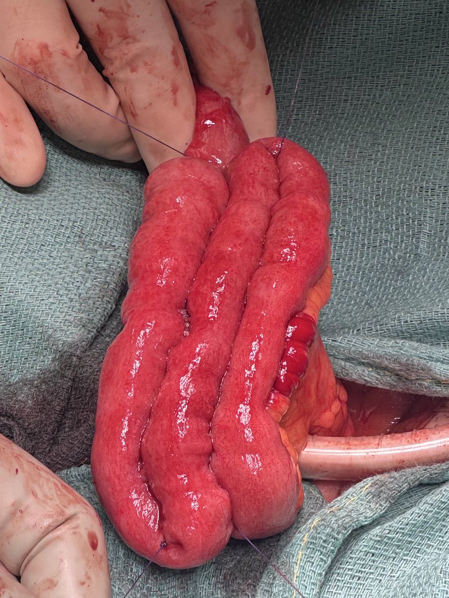 Dr Feza Remzi (@fezaremzimd) on Twitter photo When J doesn’t reach S pouch can
2% approximately chance = additional trainning and subspecilization in IBD surgery must be the present & the future.
<a href="/NorthwellHealth/">Northwell Health</a> When J doesn’t reach S pouch can
2% approximately chance = additional trainning and subspecilization in IBD surgery must be the present & the future.
<a href="/NorthwellHealth/">Northwell Health</a>