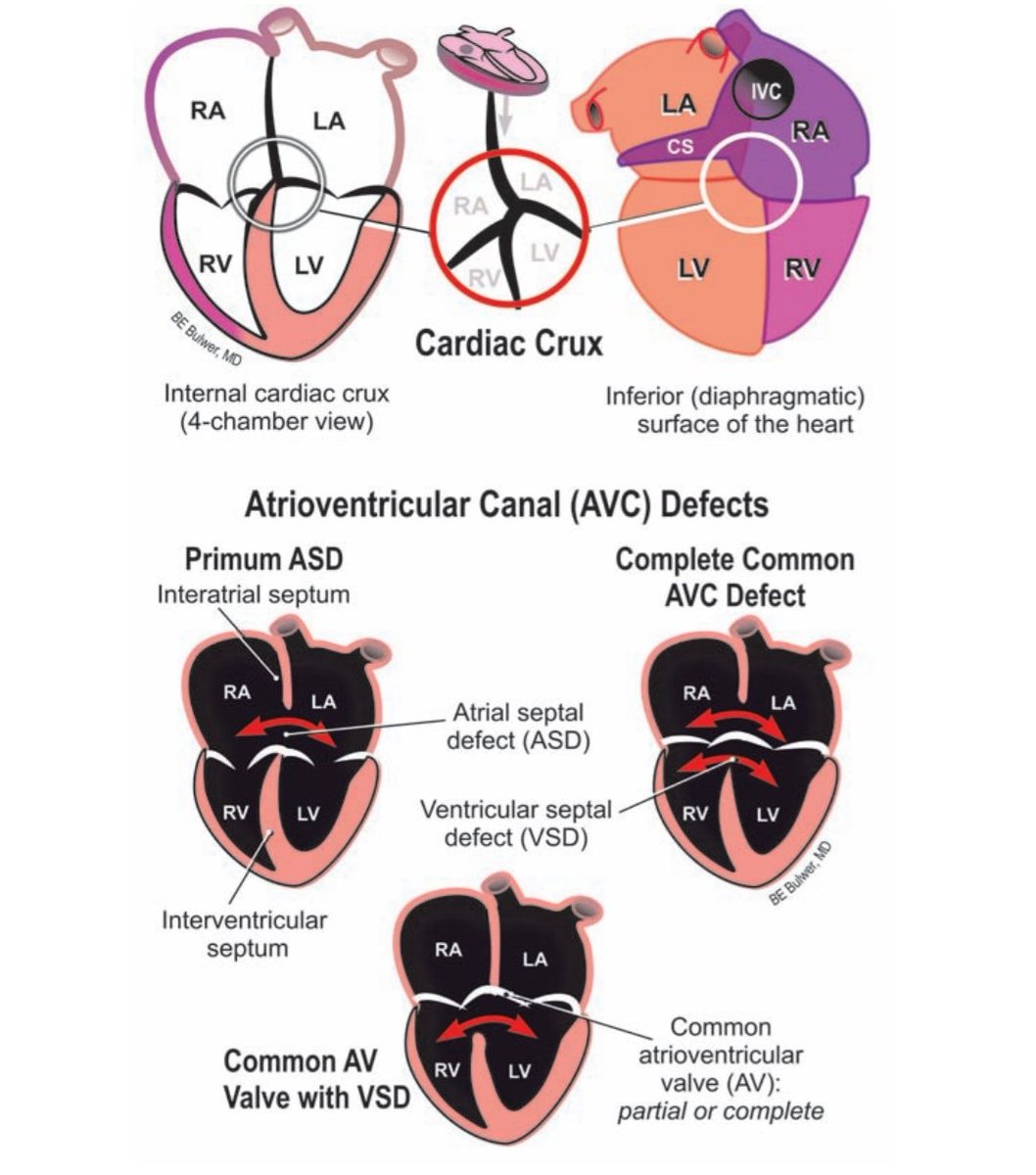 Understanding the Cardiac Crux &amp; AVC Defects on 2D Echo

The cardiac crux marks the intersection of the atrial &amp; ventricular septa and the AV valve insertions. Normally, the tricuspid valve inserts more apically than the mitral, an essential clue in congenital heart disease.

In