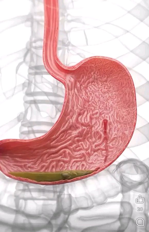 Don’t Ignore Acidity – It Could Be the First Sign of an Ulcer.

Thread 🧵