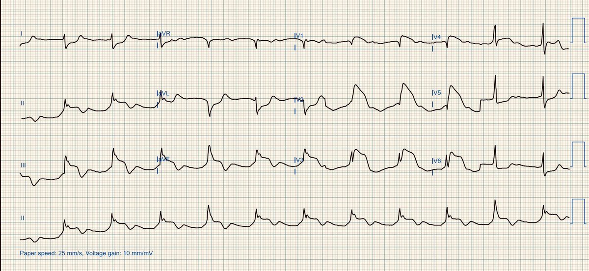 Elderly man, DM2, no chest pain but feeling unwell, vomiting, SOB. What do you see?