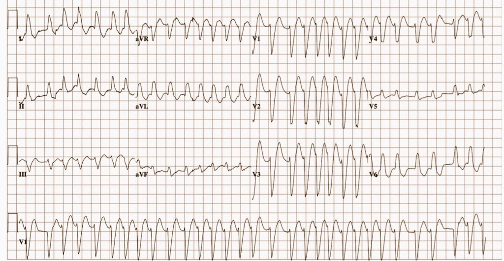 1️⃣ History of an anterior MI
2️⃣ Palpitations 
Dx?